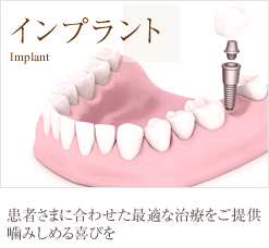 インプラント
患者さまに合わせた最適な治療をご提供噛みしめる喜びを